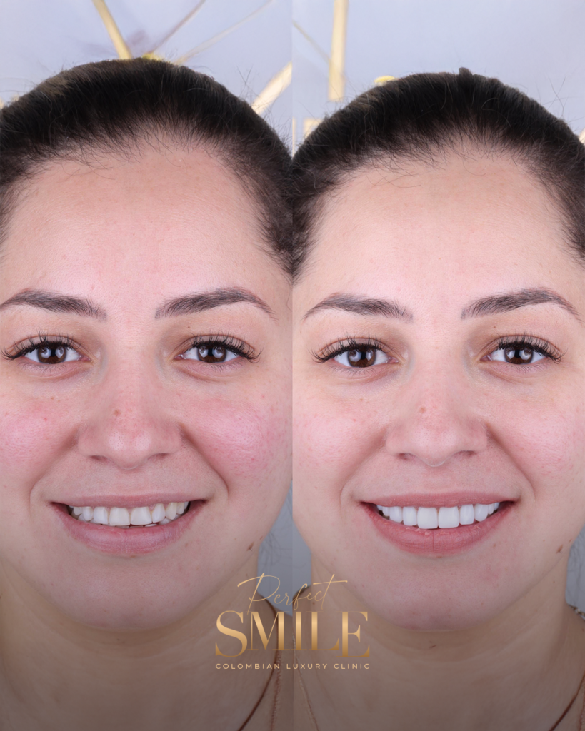 Perfect-Smile-Parrilla-Noviembre-Estaticos-11-Nov